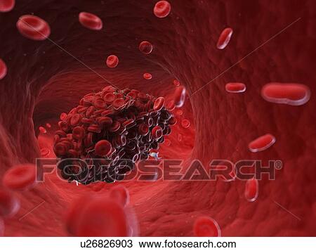 Stock Image - Illustration of a blood clot.. Fotosearch