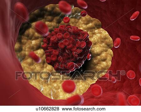 Illustration of a blood clot. View Large Photo Image Stock Photo - Illustration of a blood clot.. Fotosearch