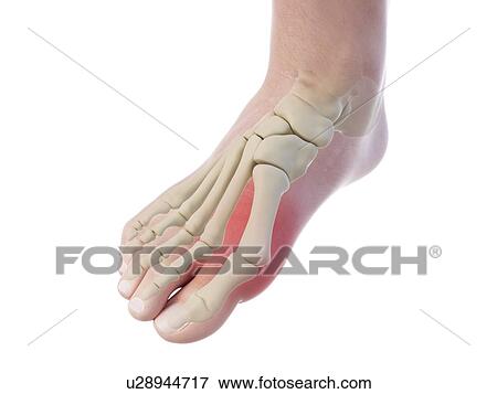 Illustration of a bunion. View Large Photo Image Stock Photo - Illustration of a bunion.. Fotosearch