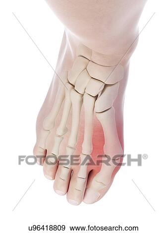 Stock Photo - Illustration of a bunion.. Fotosearch