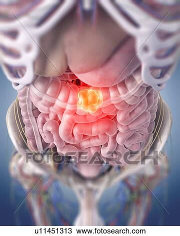 Stock Image - Illustration of a colon tumour.. Fotosearch