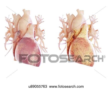 Illustration of a fatty heart. View Large Photo Image Stock Image - Illustration of a fatty heart.. Fotosearch