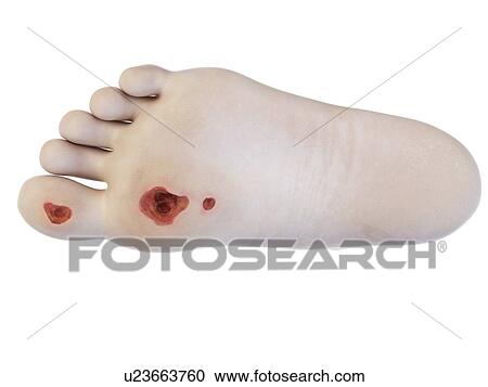 Illustration of a foot ulcer. View Large Photo Image Stock Image - Illustration of a foot ulcer.. Fotosearch