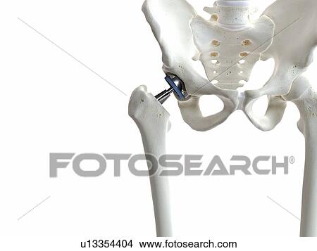 Illustration of a hip replacement. View Large Photo Image Picture - Illustration of a hip replacement.. Fotosearch