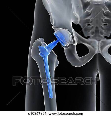 Stock Image - Illustration of a hip replacement.. Fotosearch