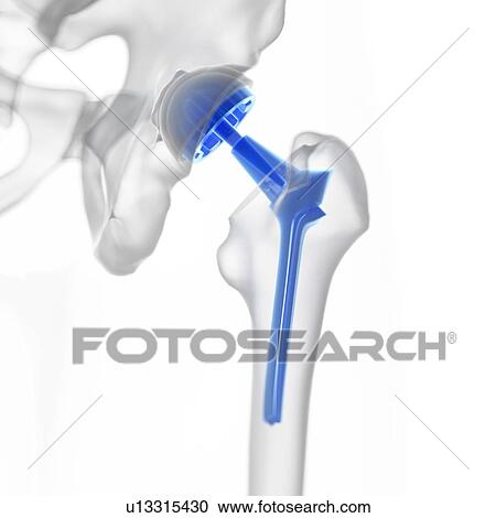 Stock Image - Illustration of a hip replacement.. Fotosearch