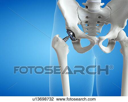 Illustration of a hip replacement. View Large Photo Image Stock Image - Illustration of a hip replacement.. Fotosearch