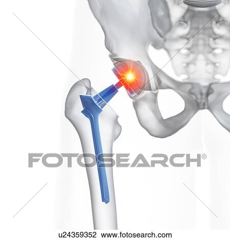 Stock Image - Illustration of a hip replacement.. Fotosearch