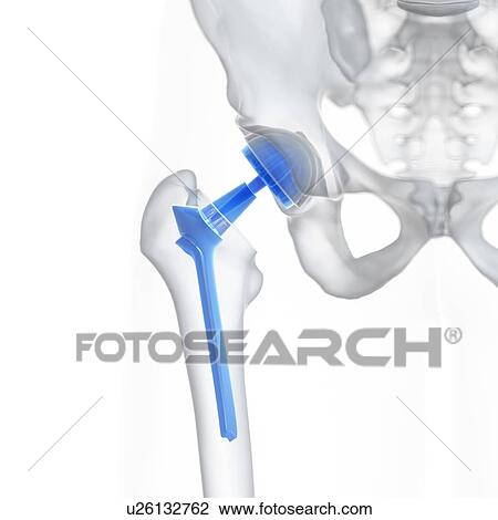 Stock Image - Illustration of a hip replacement.. Fotosearch