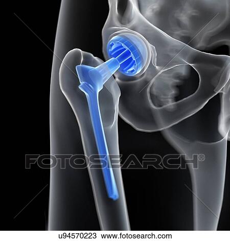 Illustration of a hip replacement. View Large Photo Image Stock Image - Illustration of a hip replacement.. Fotosearch