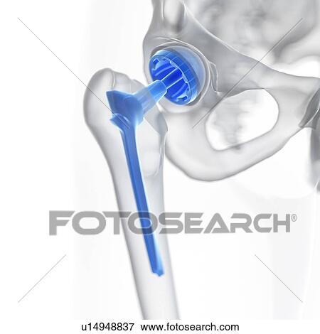 Stock Photo - Illustration of a hip replacement.. Fotosearch