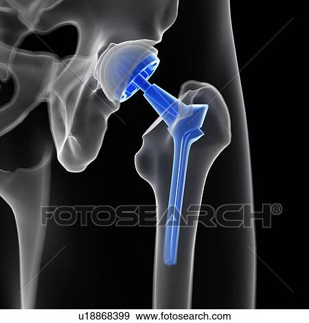 Stock Photo - Illustration of a hip replacement.. Fotosearch