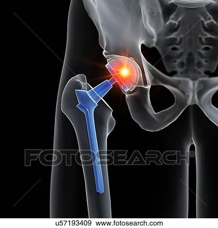 Illustration of a hip replacement. View Large Photo Image Stock Photo - Illustration of a hip replacement.. Fotosearch