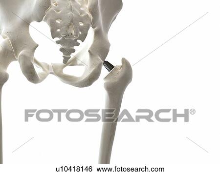 Illustration of a hip replacement. View Large Photo Image Stock Photograph - Illustration of a hip replacement.. Fotosearch