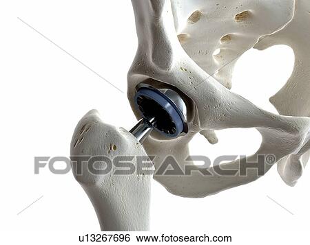 Illustration of a hip replacement. View Large Photo Image Stock Photograph - Illustration of a hip replacement.. Fotosearch