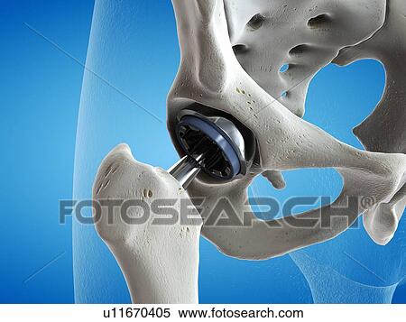 Stock Photography - Illustration of a hip replacement.. Fotosearch