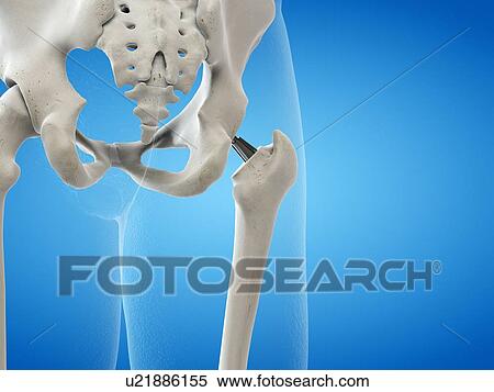 Illustration of a hip replacement. View Large Photo Image Stock Photography - Illustration of a hip replacement.. Fotosearch