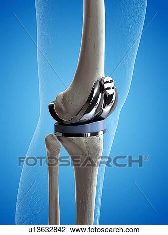 Illustration of a knee replacement. View Large Photo Image Stock Image - Illustration of a knee replacement.. Fotosearch