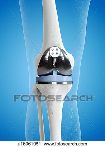 Stock Image - Illustration of a knee replacement.. Fotosearch