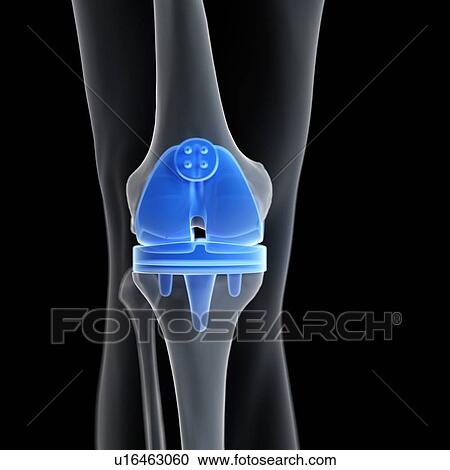 Illustration of a knee replacement. View Large Photo Image Stock Image - Illustration of a knee replacement.. Fotosearch