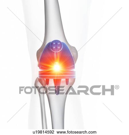 Stock Image - Illustration of a knee replacement.. Fotosearch