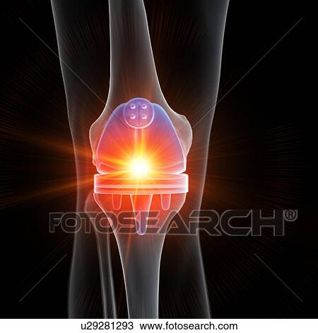 Stock Image - Illustration of a knee replacement.. Fotosearch
