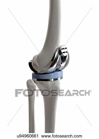Stock Image - Illustration of a knee replacement.. Fotosearch