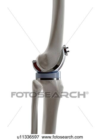 Illustration of a knee replacement. View Large Photo Image Stock Photo - Illustration of a knee replacement.. Fotosearch