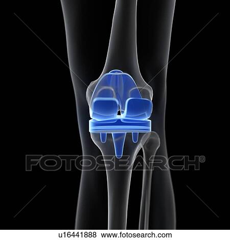 Illustration of a knee replacement. View Large Photo Image Stock Photo - Illustration of a knee replacement.. Fotosearch