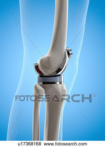 Stock Photo - Illustration of a knee replacement.. Fotosearch