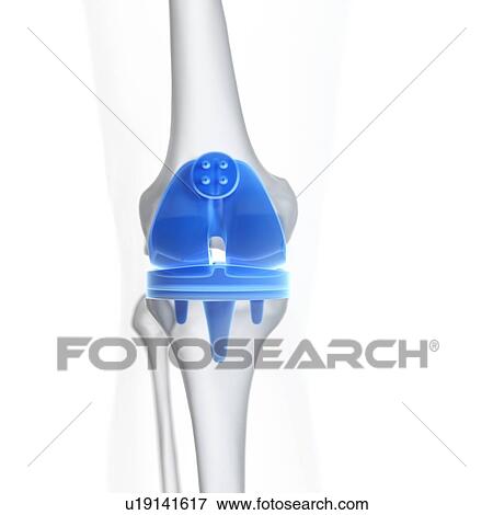 Illustration of a knee replacement. View Large Photo Image Stock Photo - Illustration of a knee replacement.. Fotosearch