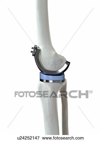 Illustration of a knee replacement. View Large Photo Image Stock Photo - Illustration of a knee replacement.. Fotosearch