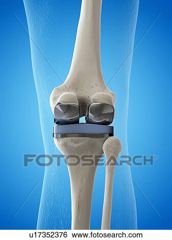 Illustration of a knee replacement. View Large Photo Image Stock Photograph - Illustration of a knee replacement.. Fotosearch
