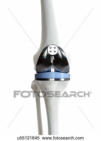Stock Photography - Illustration of a knee replacement.. Fotosearch