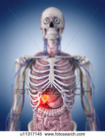 Stock Photography - Illustration of a liver tumour.. Fotosearch