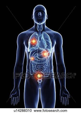 Stock Image - Illustration of a man with metastases.. Fotosearch