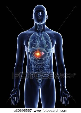 Stock Photo - Illustration of a man's adrenal glands cancer.. Fotosearch