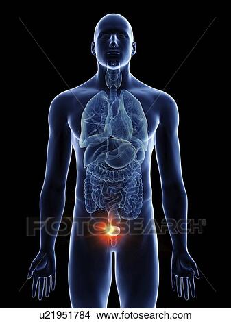 Picture - Illustration of a man's bladder cancer.. Fotosearch