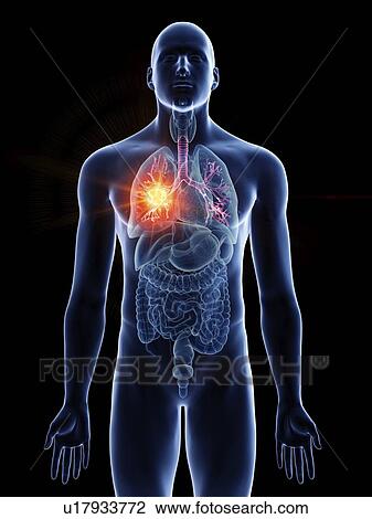 Illustration of a man's bronchi cancer. View Large Photo Image Stock Image - Illustration of a man's bronchi cancer.. Fotosearch