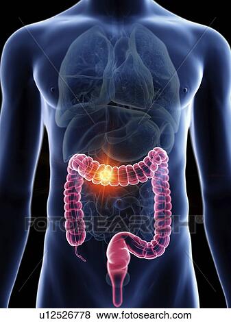 Illustration of a man's colon cancer. View Large Photo Image Stock Photo - Illustration of a man's colon cancer.. Fotosearch