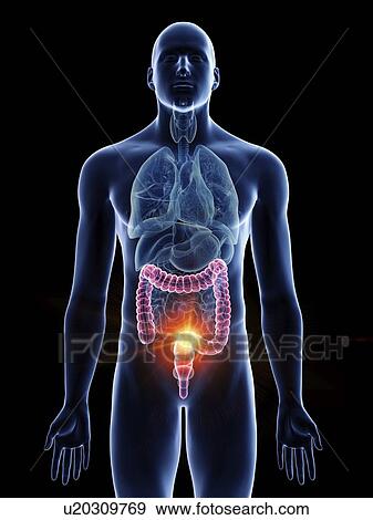 Stock Photo - Illustration of a man's colon cancer.. Fotosearch