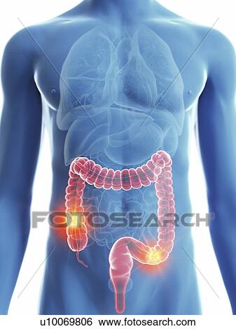 Illustration of a man's colon cancer. View Large Photo Image Stock Photograph - Illustration of a man's colon cancer.. Fotosearch