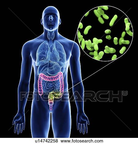 Stock Photo - Illustration of a man's colon infection.. Fotosearch