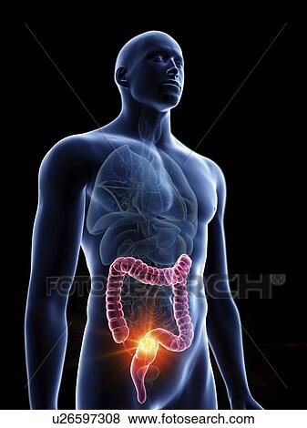 Stock Photo - Illustration of a man's colon tumour.. Fotosearch