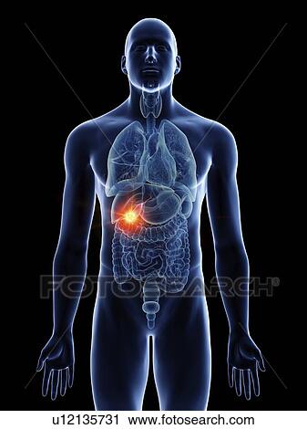 Illustration of a man's gallbladder cancer. View Large Photo Image Stock Image - Illustration of a man's gallbladder cancer.. Fotosearch