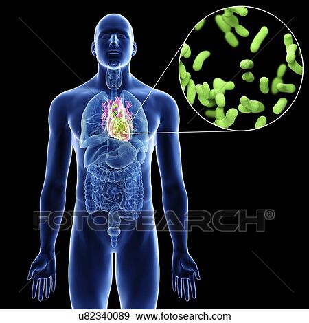 Illustration of a man's heart infection. View Large Photo Image Stock Photo - Illustration of a man's heart infection.. Fotosearch