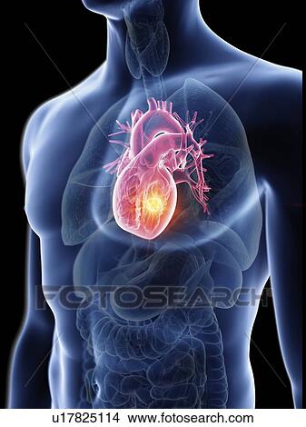 Illustration of a man's heart tumour. View Large Photo Image Picture - Illustration of a man's heart tumour.. Fotosearch