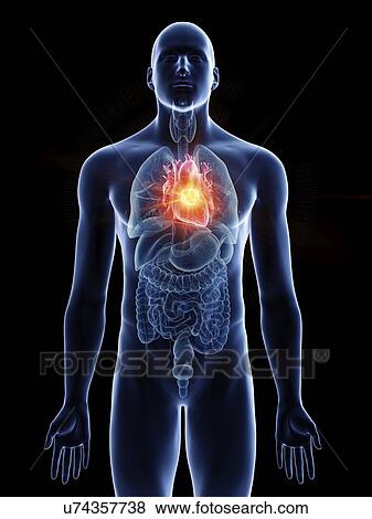 Stock Photo - Illustration of a man's heart tumour.. Fotosearch