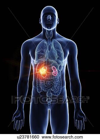 Stock Image - Illustration of a man's kidney cancer.. Fotosearch