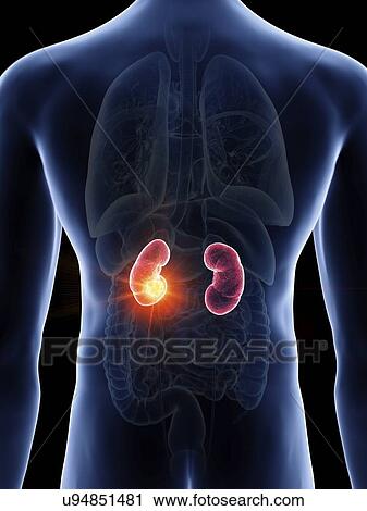 Stock Image - Illustration of a man's kidney cancer.. Fotosearch